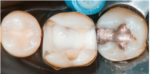 Kulzer Charisma Flow Flowable Composite - Image 4